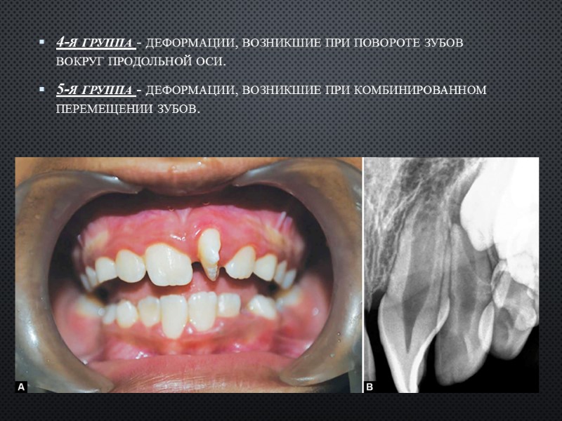 4-я группа - деформации, возникшие при по­вороте зубов вокруг продольной оси. 5-я группа -